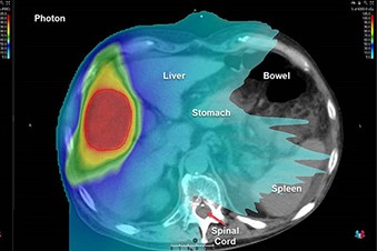 an example of treatment for a liver tumor comparing proton and X-ray radiation